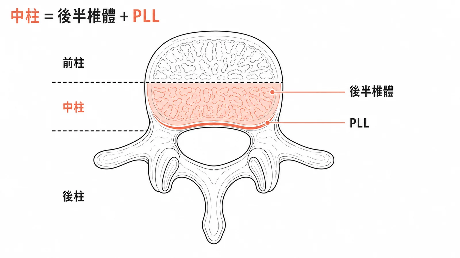 Denis三柱理論：中柱由椎體後半部與後縱韌帶PLL組成