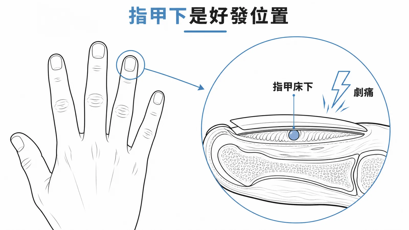 球狀血管瘤好發於指甲床下，典型症狀為劇痛