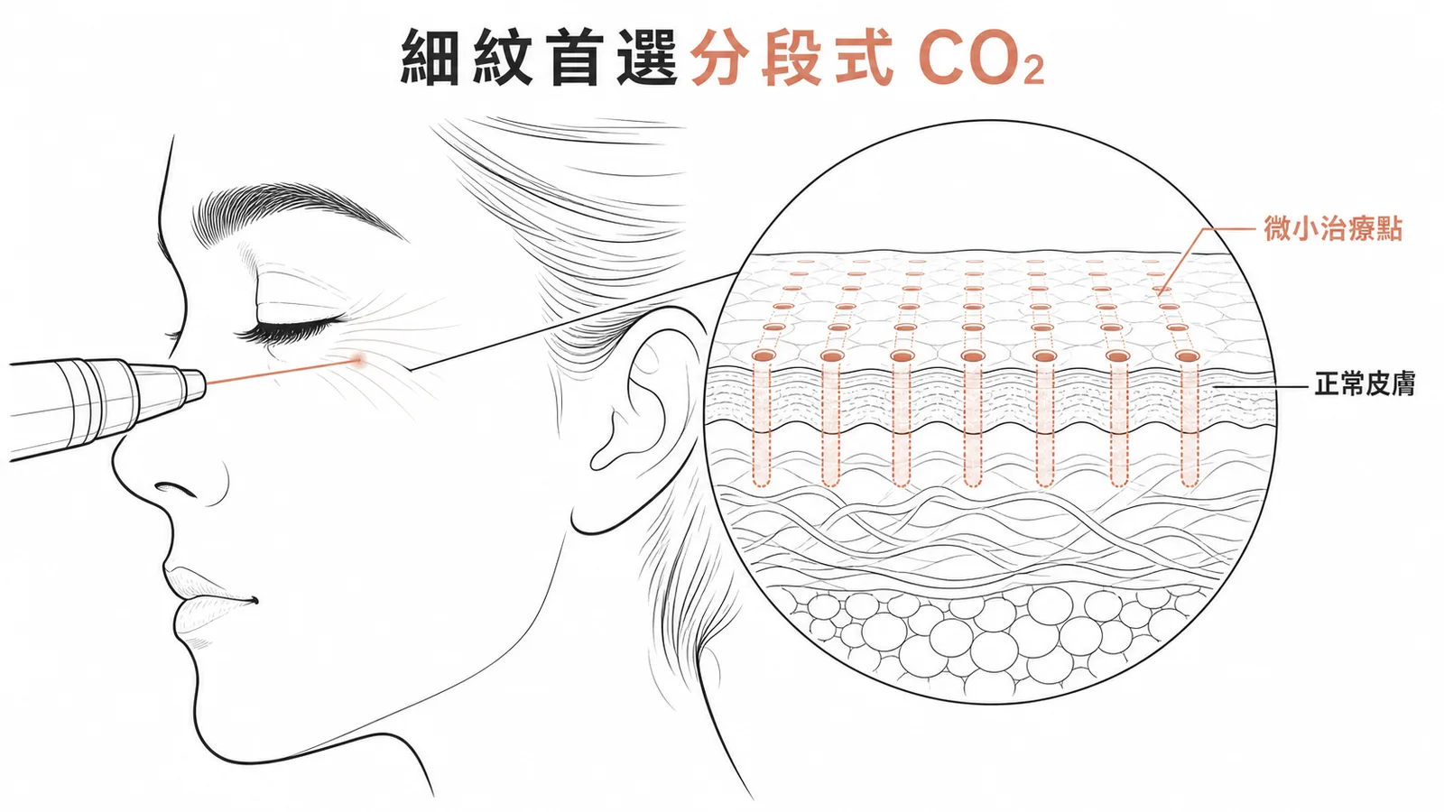 去除細紋首選分段式CO₂雷射:微小治療點間保留正常皮膚