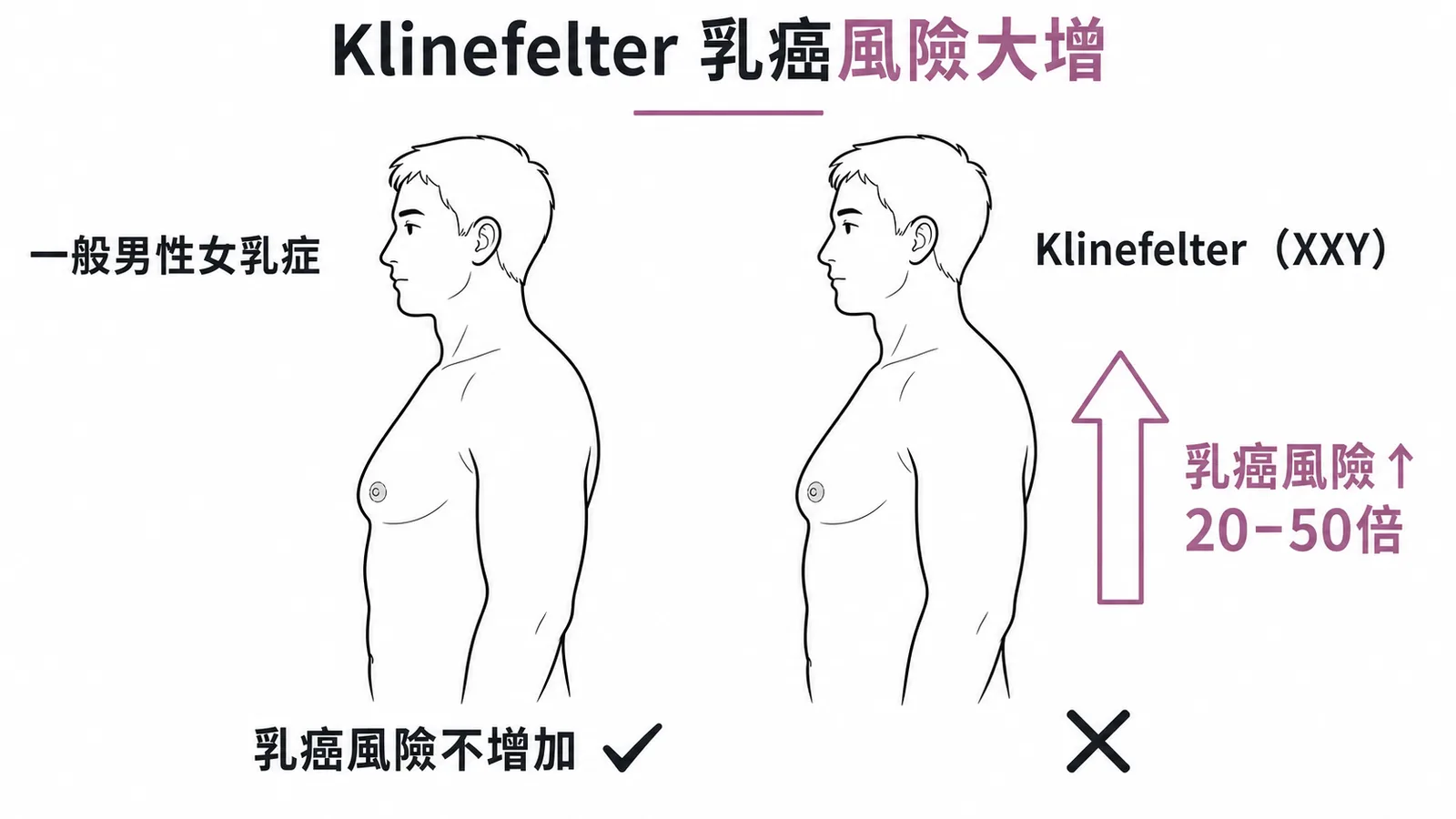 Klinefelter症候群男性女乳症合併乳癌風險增加20至50倍