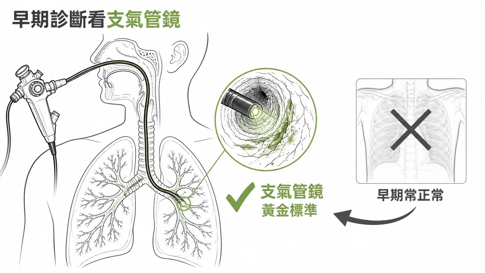 吸入性灼傷早期診斷:支氣管鏡為黃金標準,胸部X光早期正常無法診斷