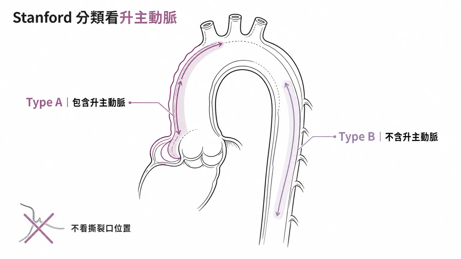 Stanford分類:Type A包含升主動脈,Type B不含,分類看剝離範圍而非撕裂口位置