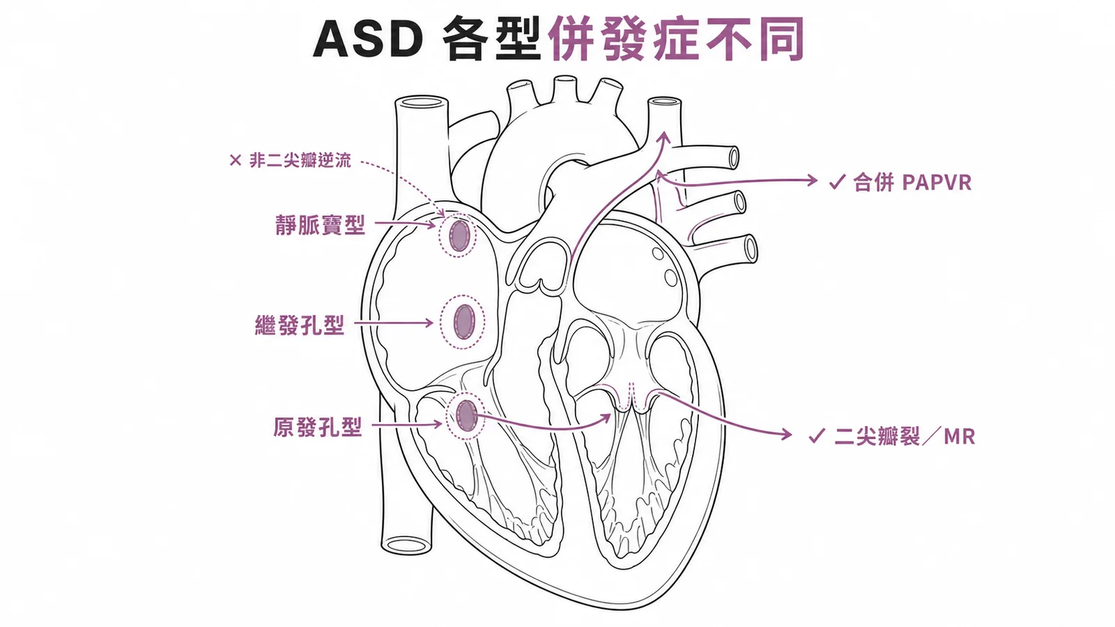 ASD各型併發症：靜脈竇型合併PAPVR，原發孔型合併二尖瓣裂MR