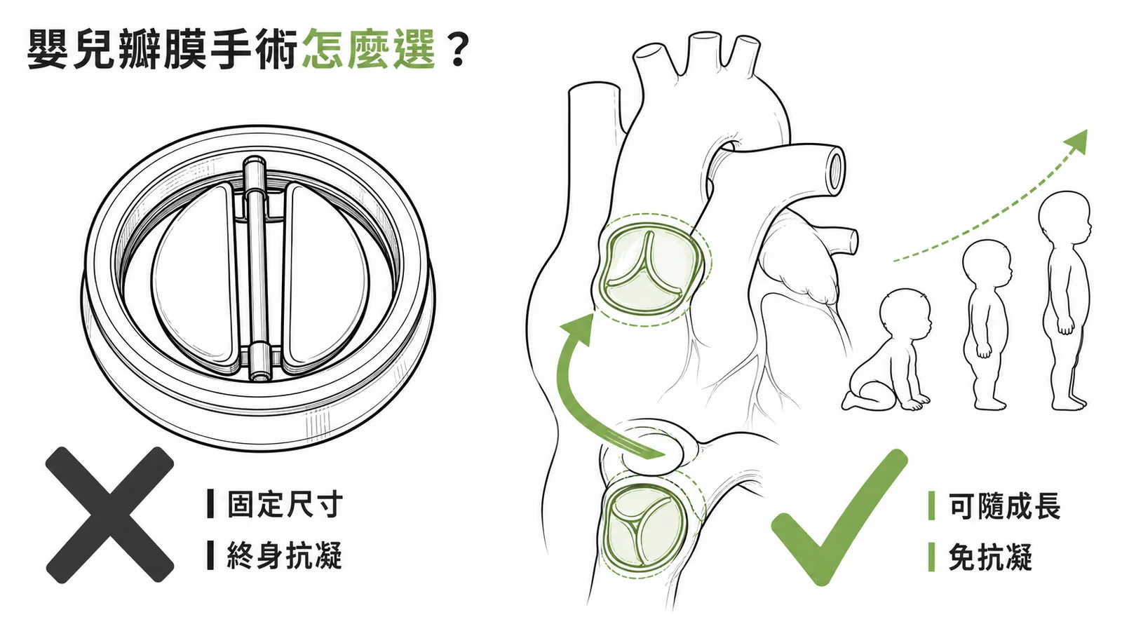 嬰兒瓣膜手術選擇:機械瓣膜固定尺寸需終身抗凝不適合,Ross procedure可隨成長免抗凝