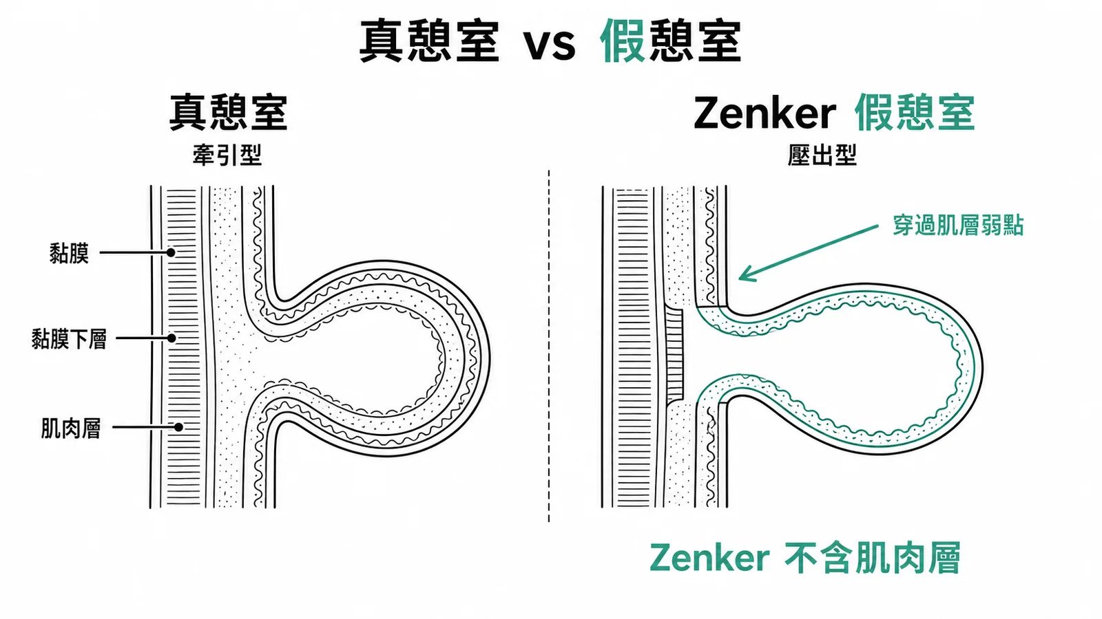 真憩室vs假憩室:Zenker咽食道憩室是壓出型假憩室,只有黏膜與黏膜下層,不含肌肉層