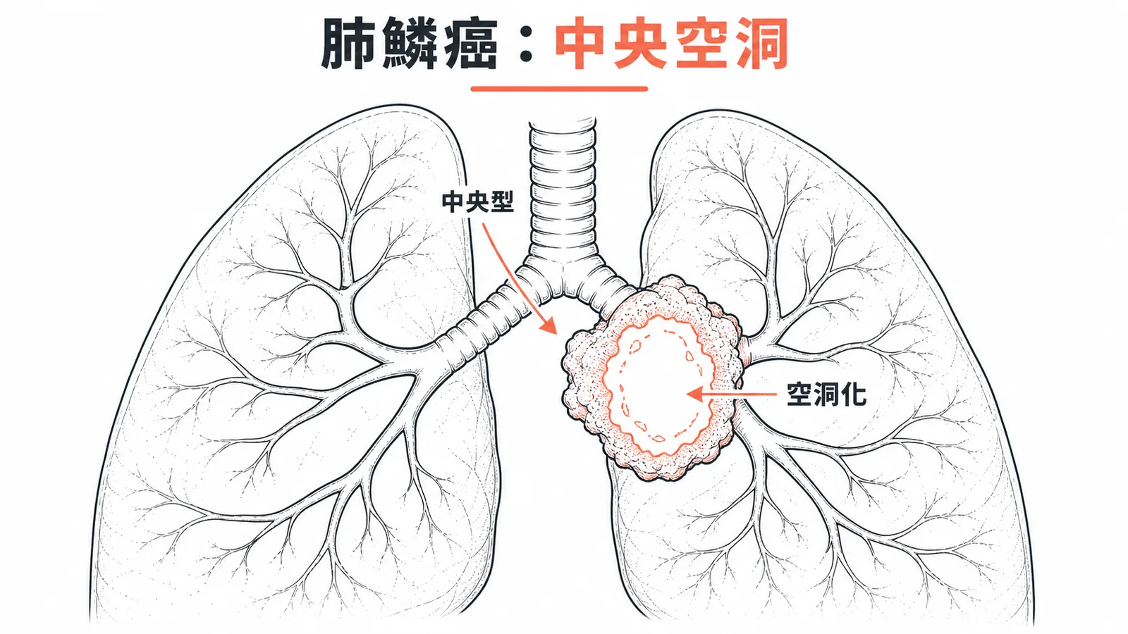 肺鱗狀上皮細胞癌特性:中央型、靠近支氣管、生長快速致中央缺血壞死形成空洞