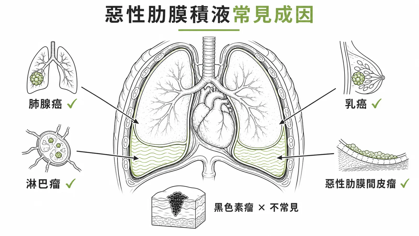 惡性肋膜積液常見成因:肺腺癌、乳癌、淋巴瘤、間皮瘤,黑色素瘤不常見