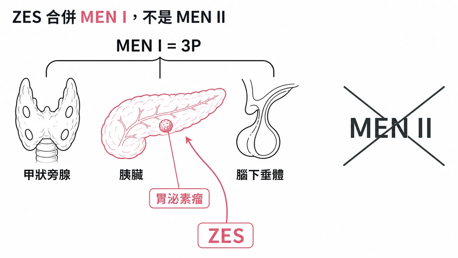ZES 合併 MEN I(3P)而非 MEN II 示意圖
