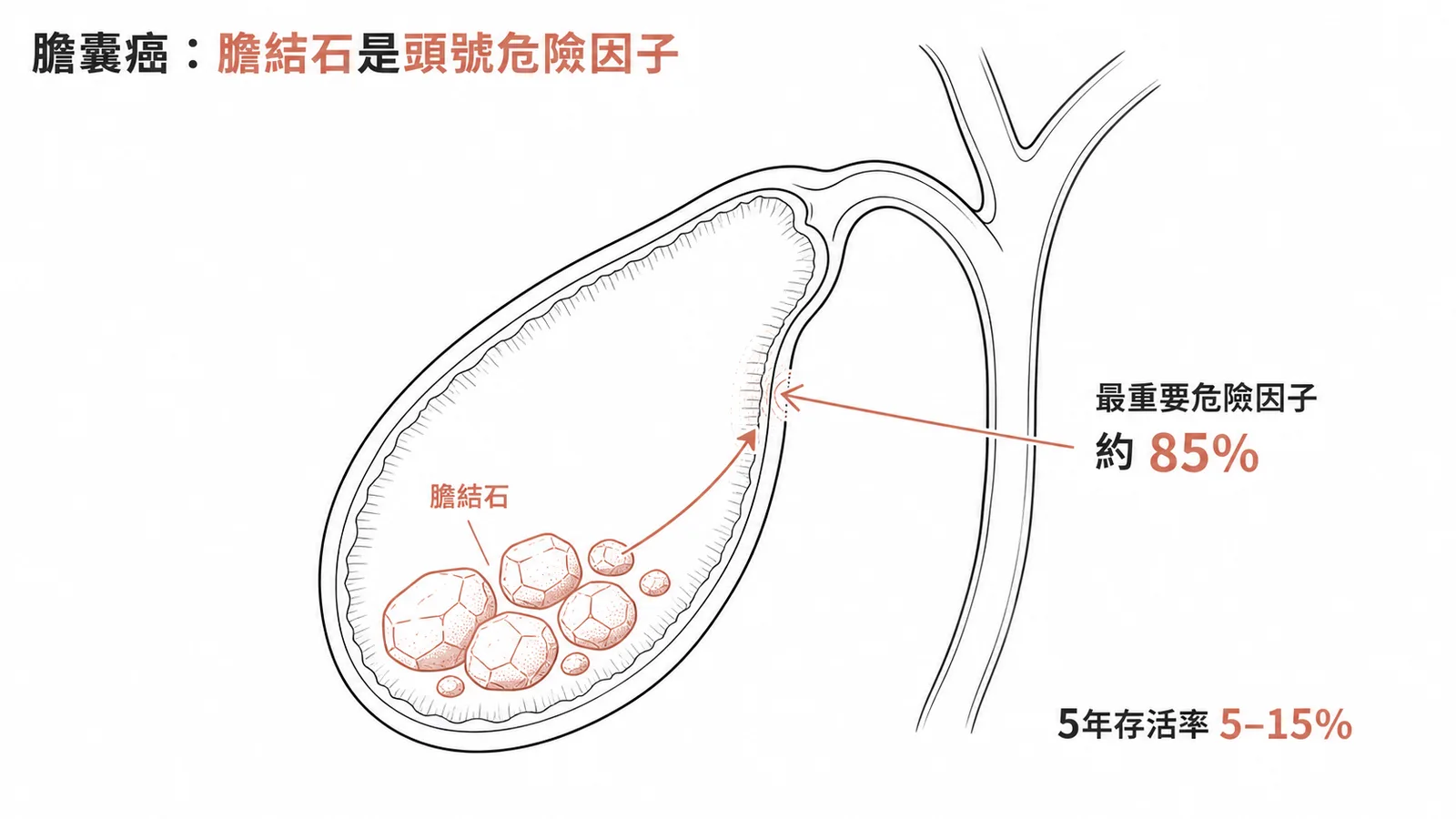 膽囊癌與膽結石關聯:約85%膽囊癌患者伴隨膽結石