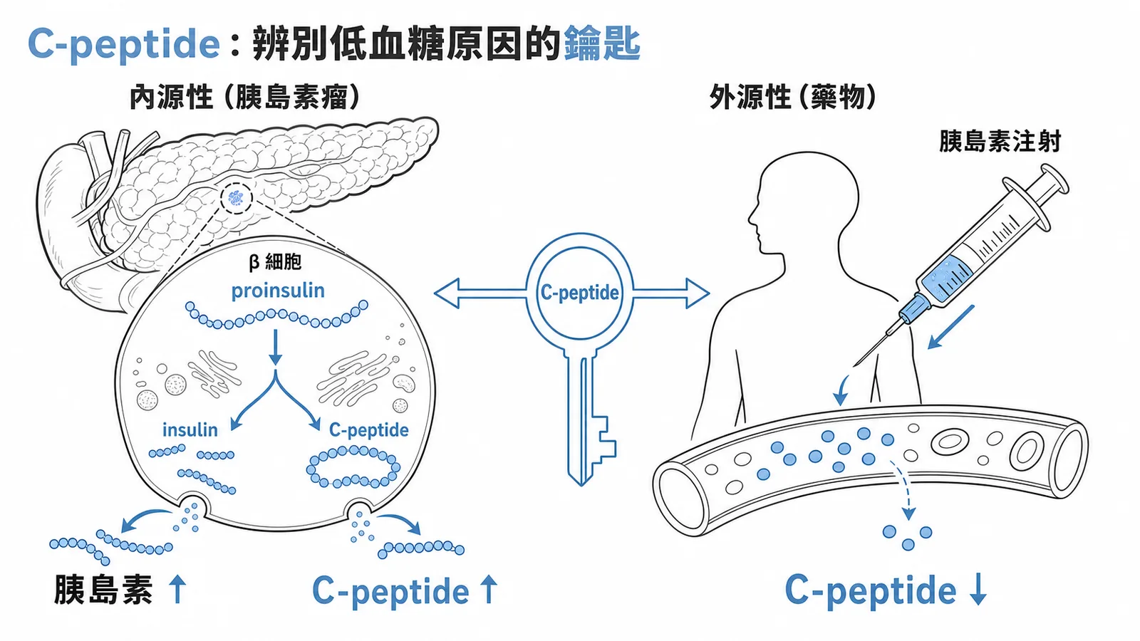 C-peptide區分內外源性低血糖:胰島素瘤C-peptide升高、外源性則下降