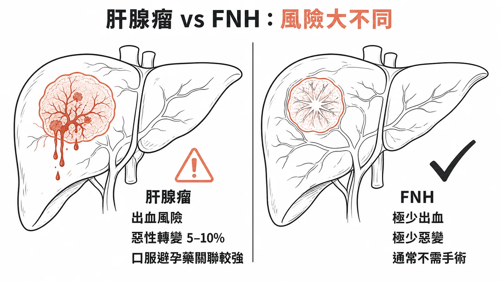 肝腺瘤vs FNH風險對照:腺瘤出血惡變風險高、FNH極少