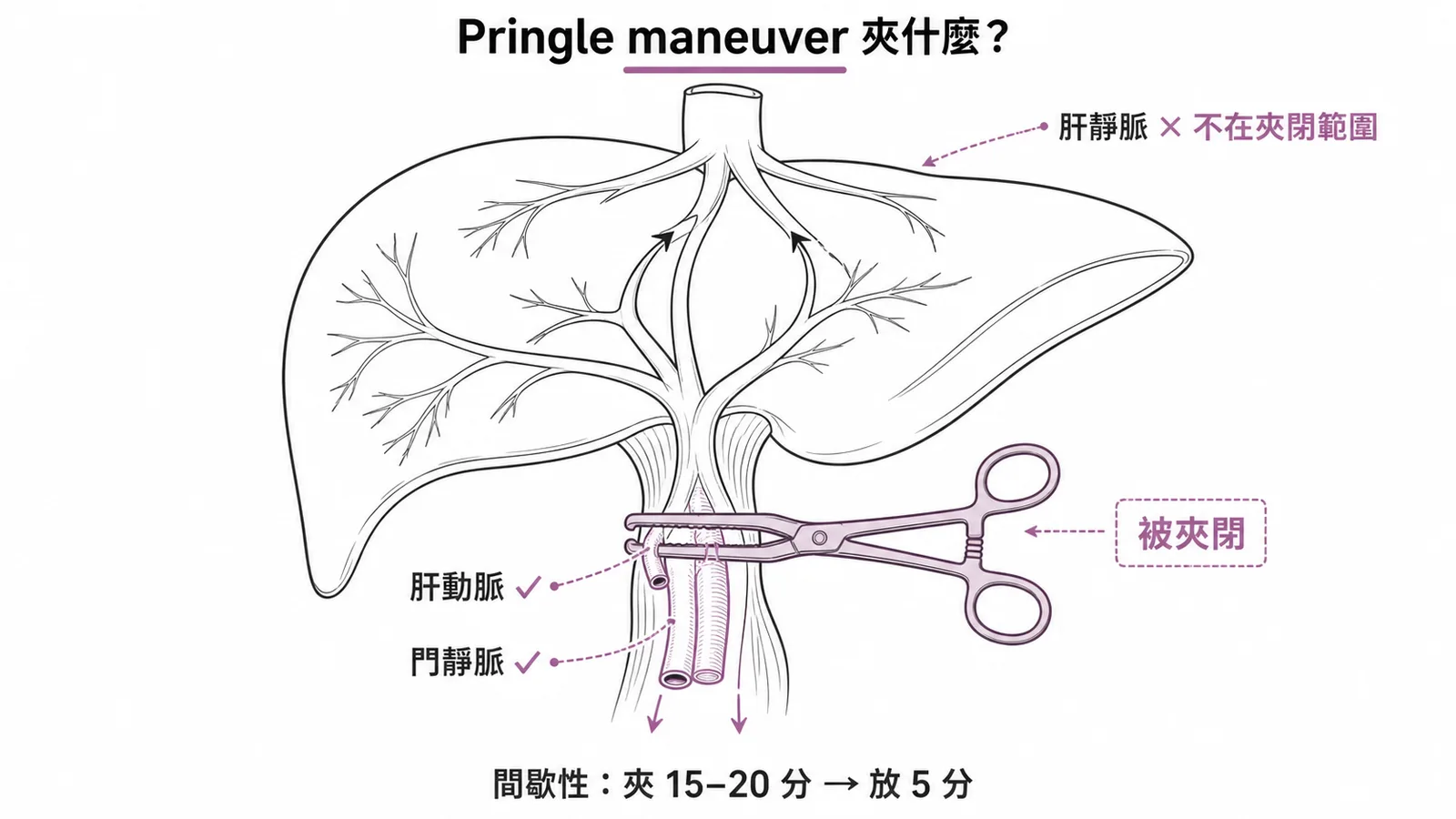 Pringle maneuver夾閉肝十二指腸韌帶:肝動脈+門靜脈被夾、肝靜脈不含
