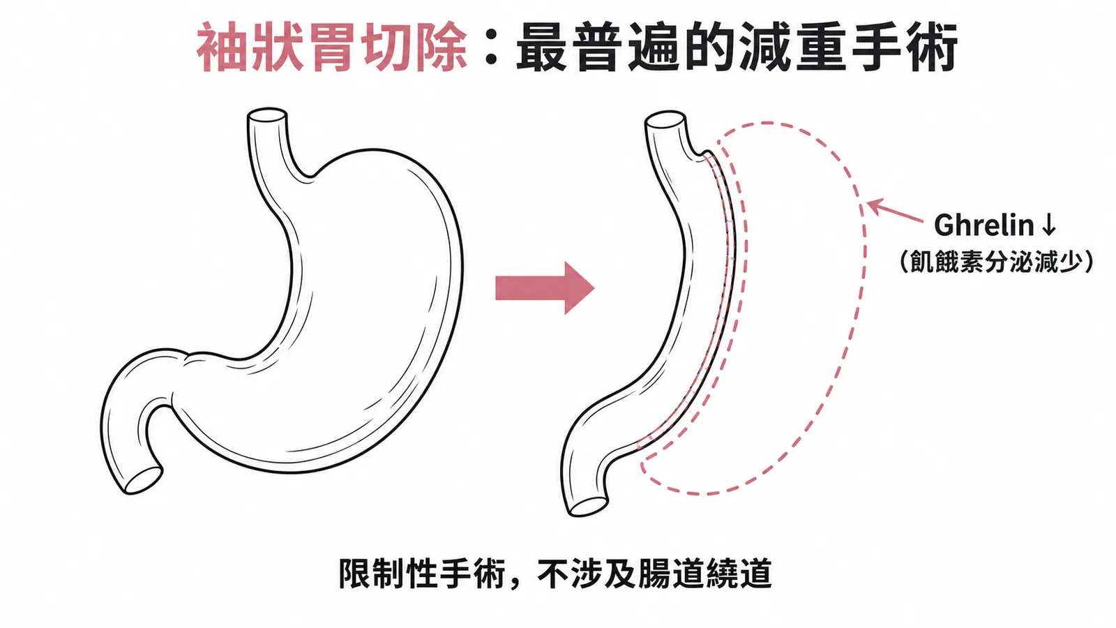 袖狀胃切除術示意:切除胃底減少Ghrelin分泌、限制性手術