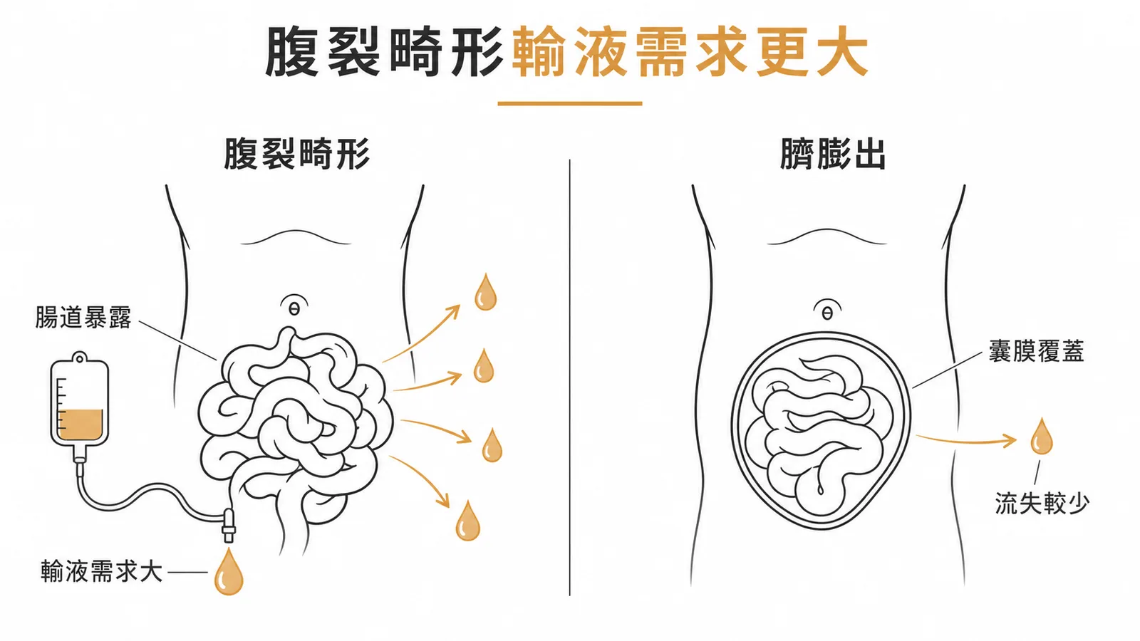 腹裂畸形輸液需求更大:腹裂畸形腸道暴露水分流失嚴重,臍膨出有囊膜覆蓋流失較少