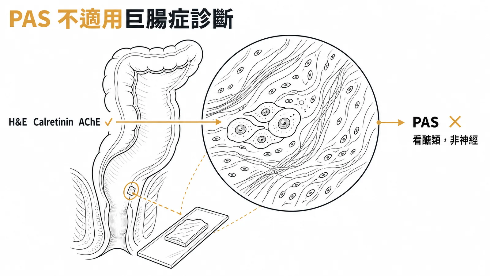 PAS 不適用巨腸症診斷:H&E、Calretinin、AChE 可觀察神經節細胞,PAS 看醣類非神經