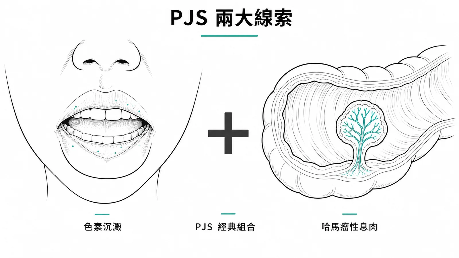 PJS 兩大線索:嘴唇色素沉澱加上哈馬瘤性息肉
