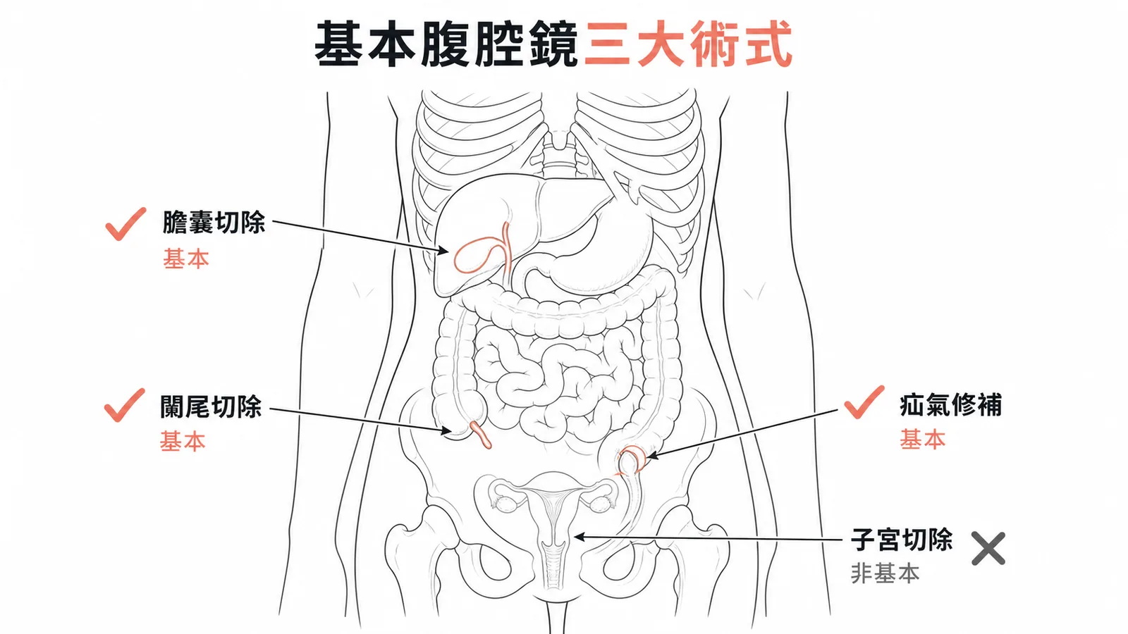 基本腹腔鏡三大術式:膽囊切除、闌尾切除、疝氣修補;子宮切除非基本