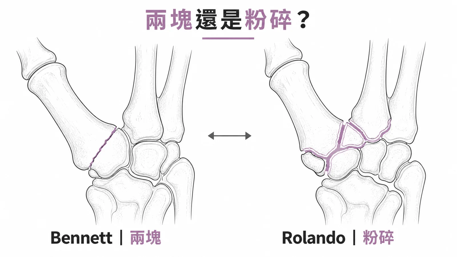 Bennett 兩塊碎片 vs Rolando 粉碎性骨折對照