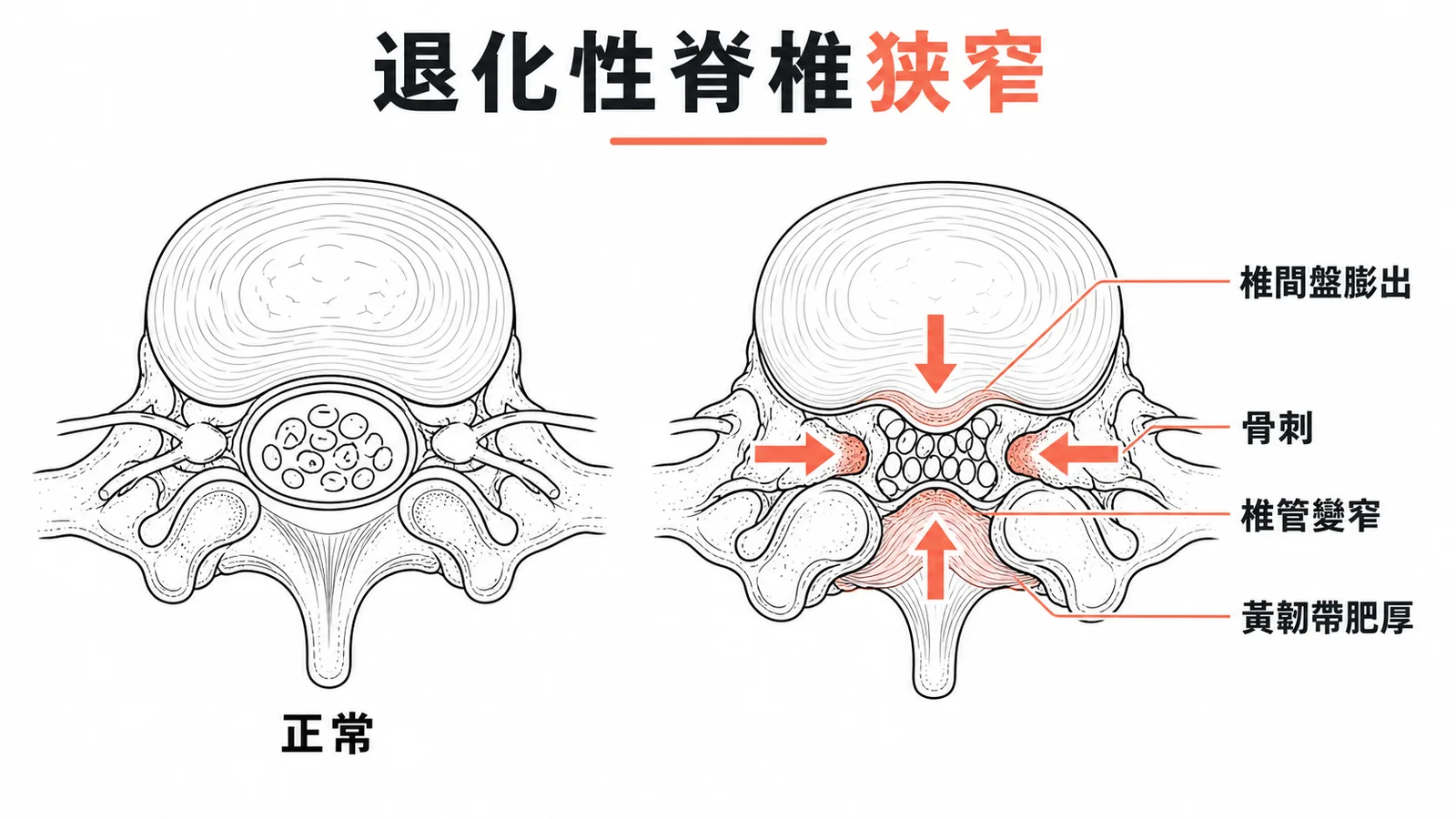 退化性脊椎狹窄：正常與狹窄椎管的橫切面對比