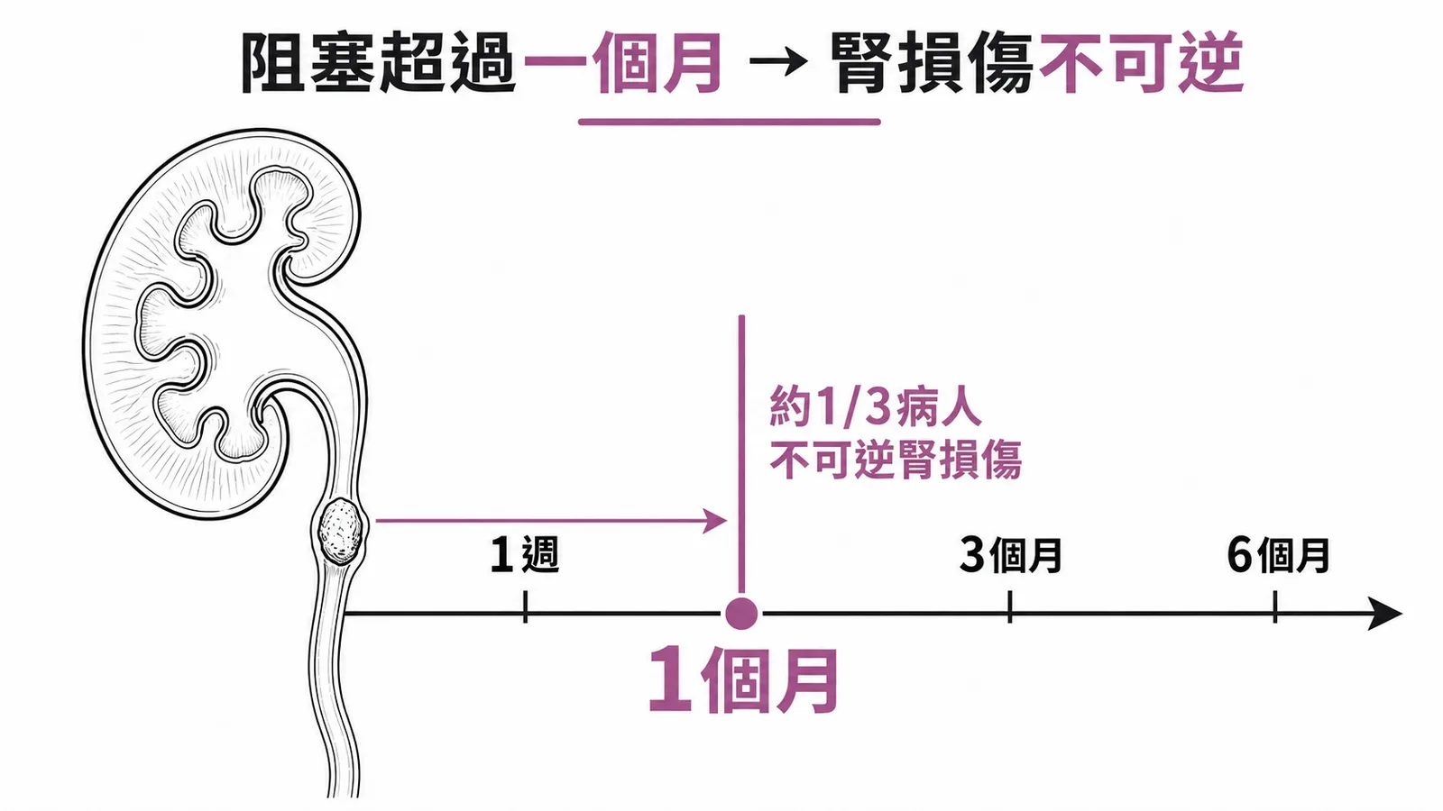 輸尿管阻塞超過一個月，約1/3病人腎功能不可逆受損