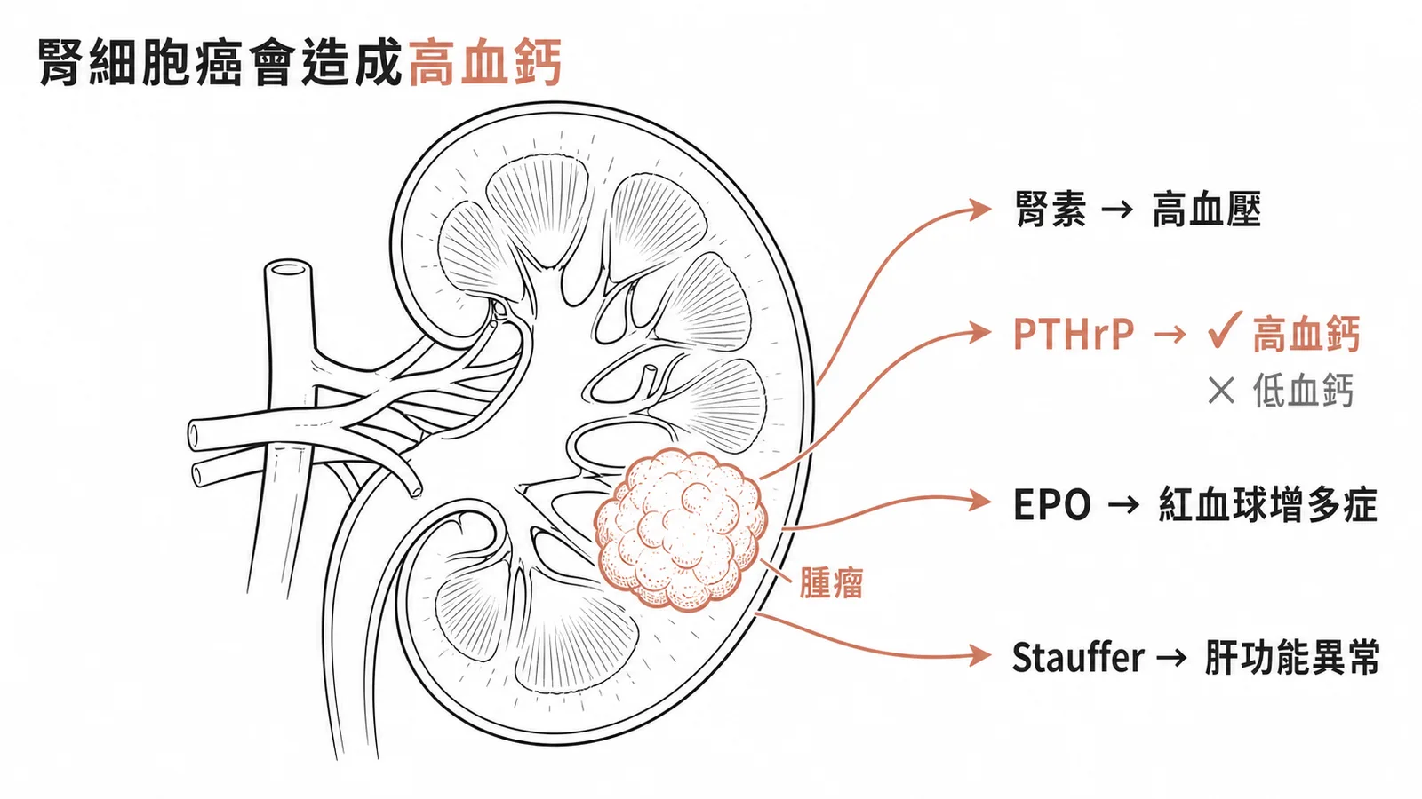 腎細胞癌副腫瘤症候群：分泌PTHrP導致高血鈣（非低血鈣）