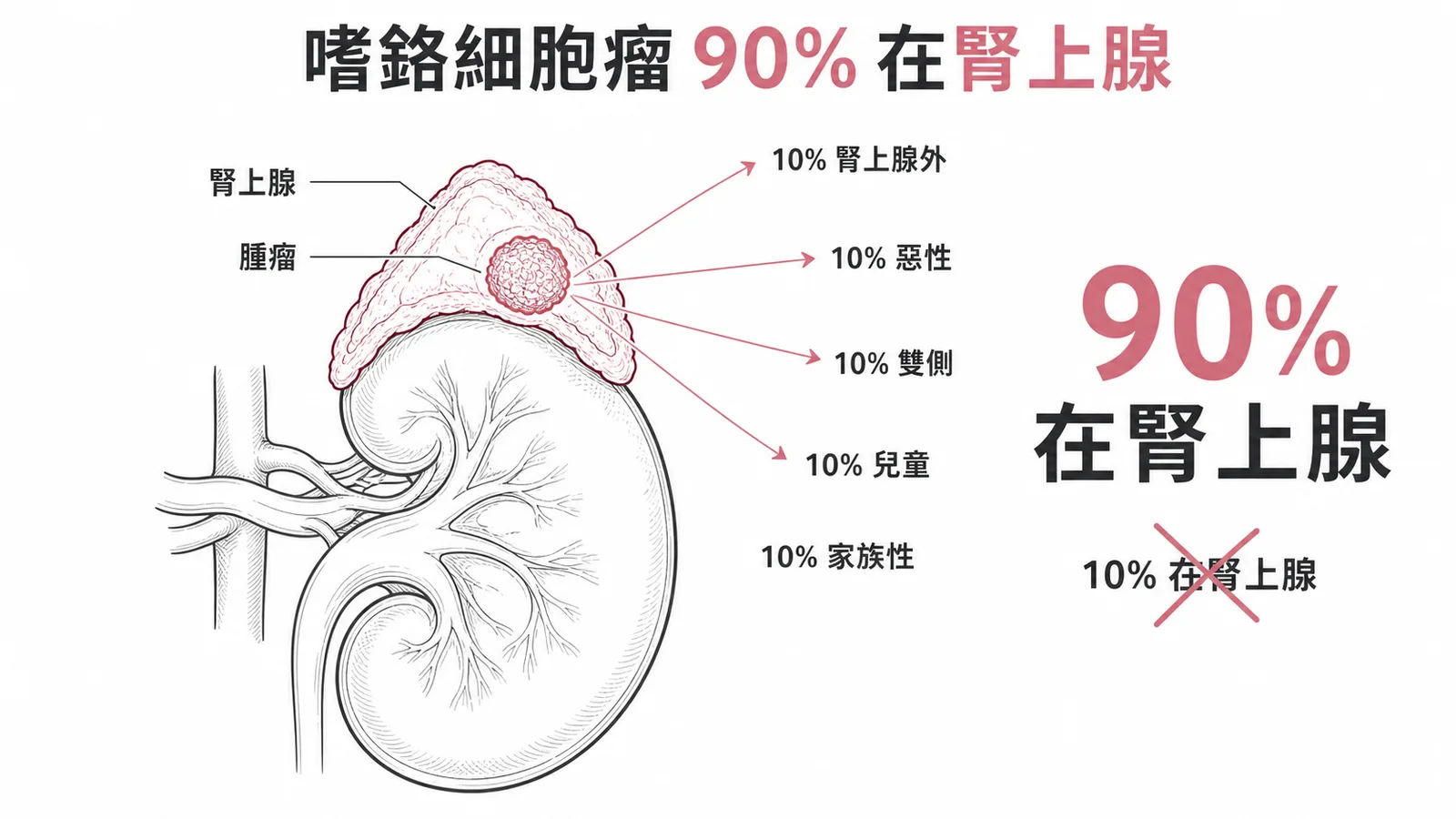嗜鉻細胞瘤10%法則:90%在腎上腺,各10%為腎上腺外、惡性、雙側、兒童、家族性