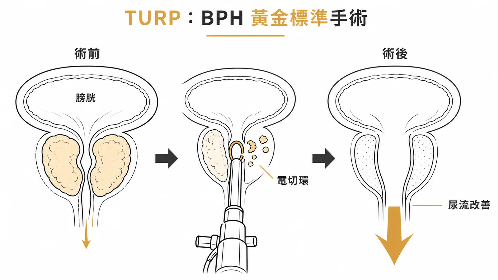 TURP手術示意：術前增生壓迫尿道 vs 術後尿道通暢、尿流改善