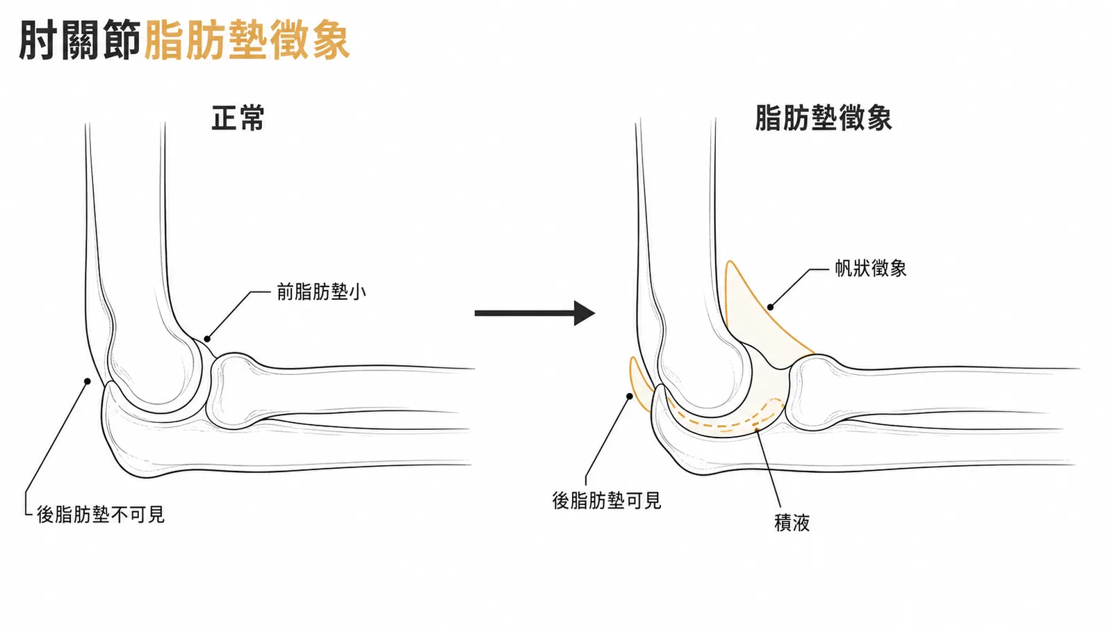 肘關節脂肪墊徵象：正常vs積液時前後脂肪墊變化