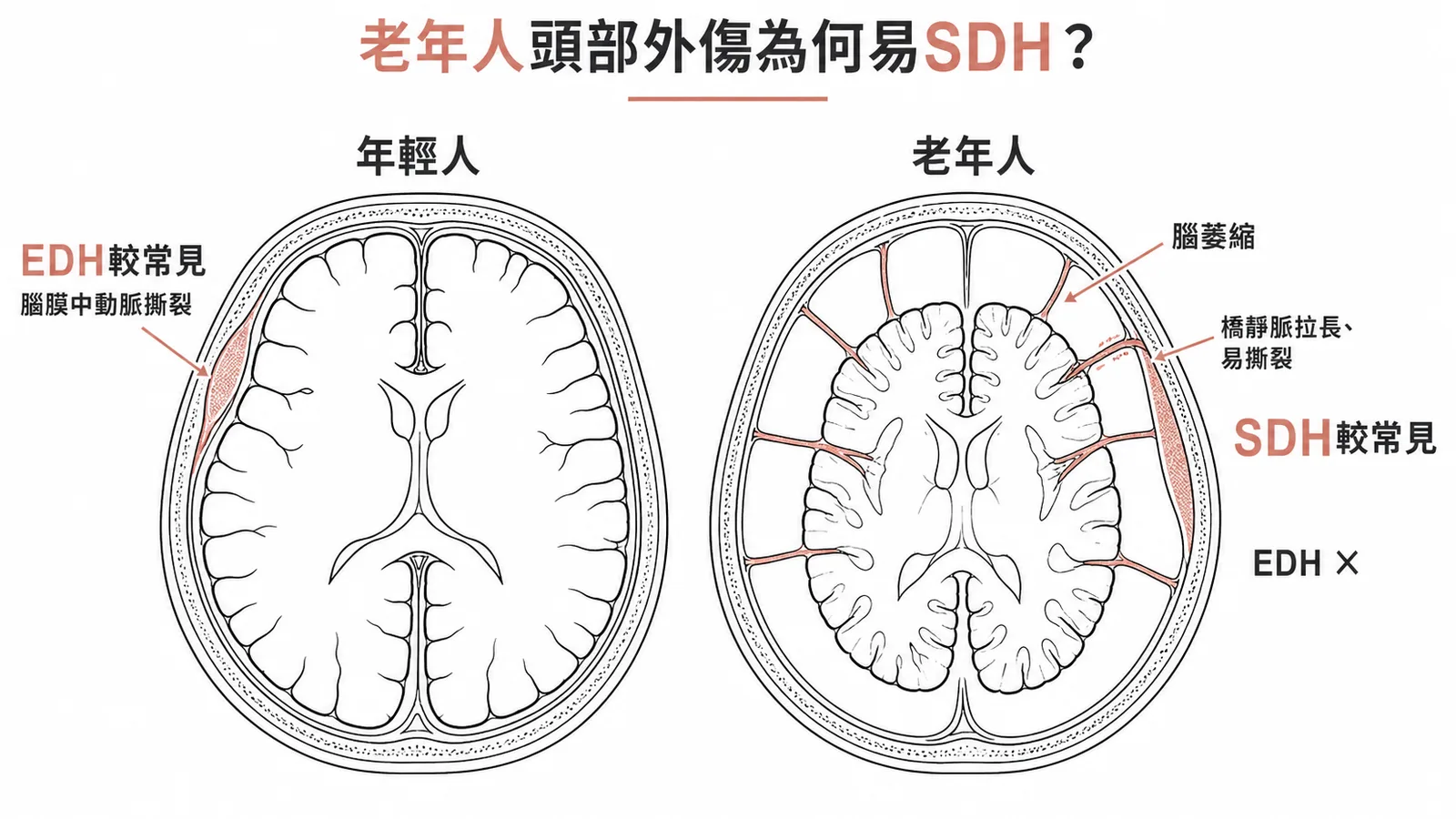 老年人腦萎縮致橋靜脈拉長,外傷後易硬腦膜下血腫