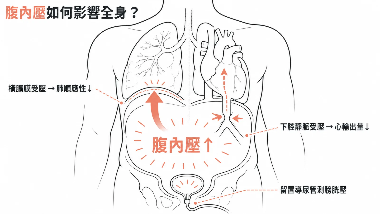 腹部腔室症候群壓力傳導示意圖：腹內壓升高向上壓迫橫膈膜致肺順應性下降，向下壓迫下腔靜脈致心輸出量降低