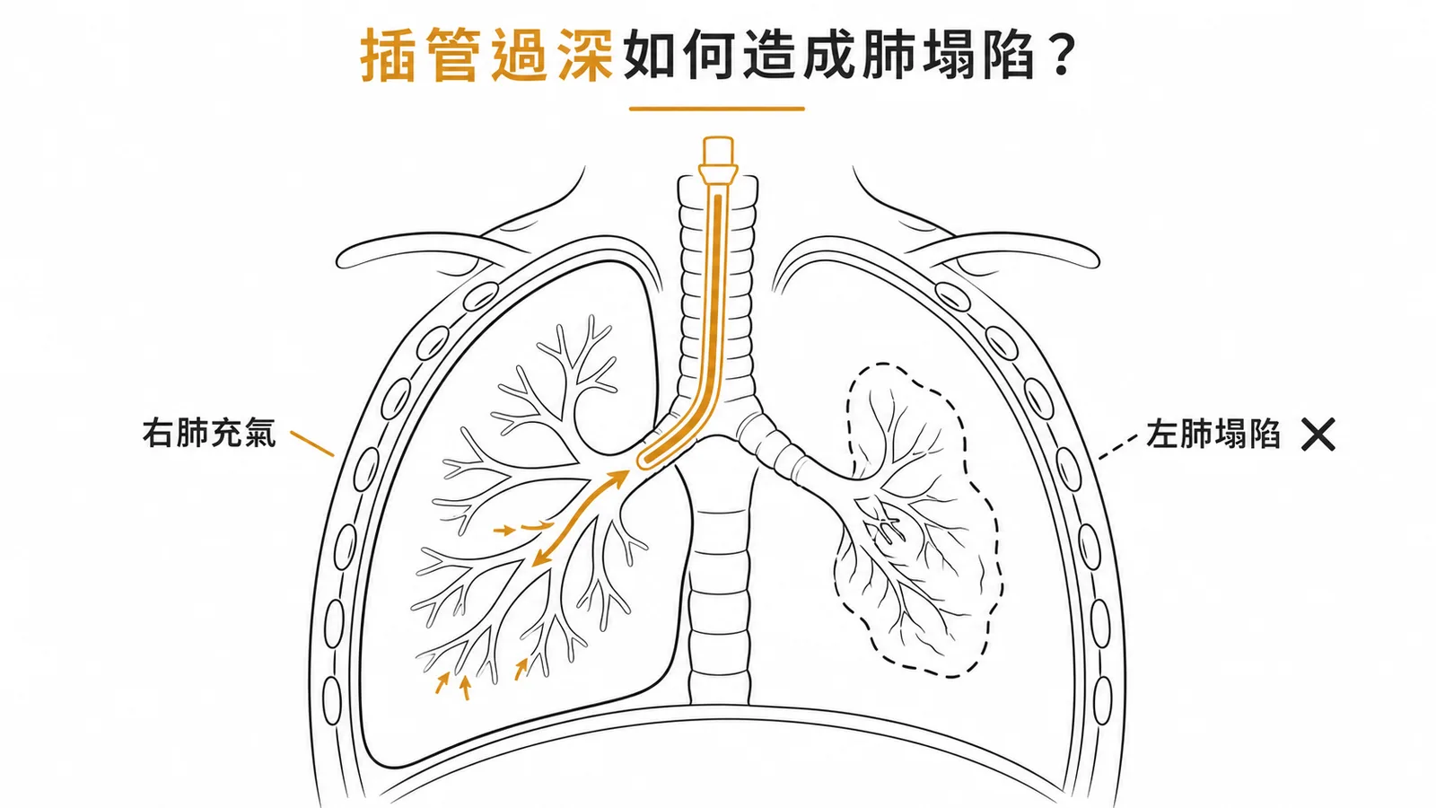 術後肺坍塌示意圖：氣管內插管過深進入右主支氣管導致左肺塌陷