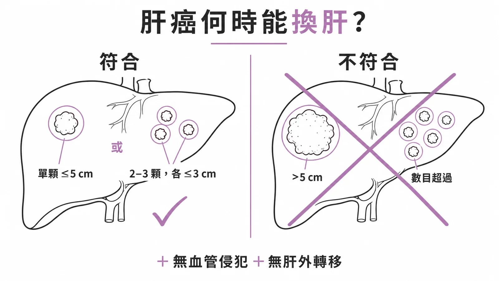米蘭準則示意圖:單顆腫瘤≤5cm或2-3顆各≤3cm加上無血管侵犯與無肝外轉移方可換肝