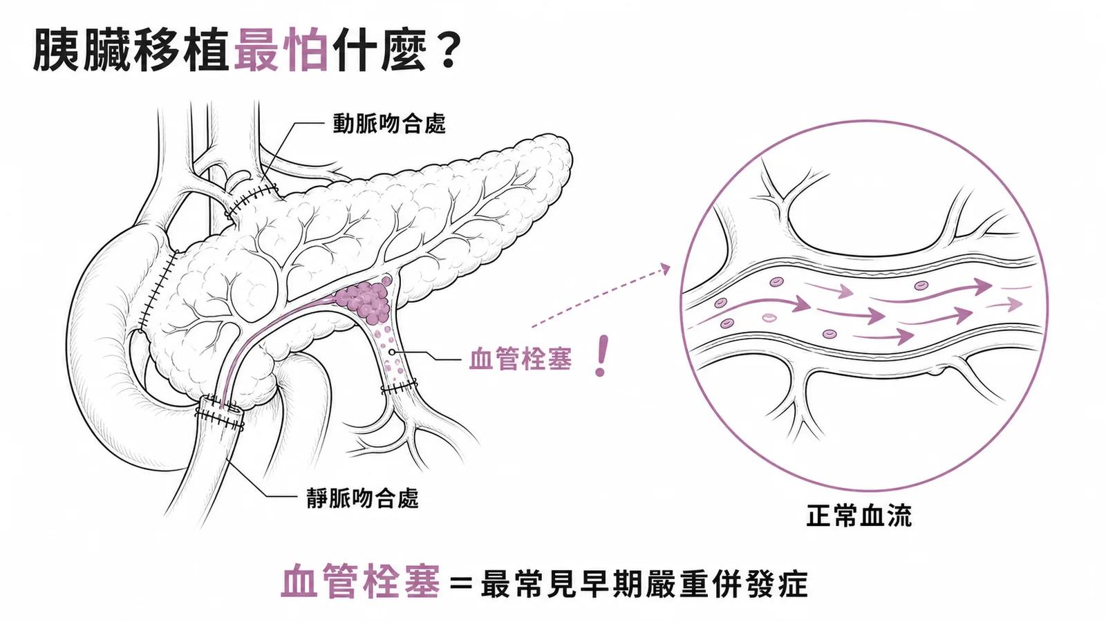 胰臟移植最常見早期嚴重併發症為移植物血管栓塞