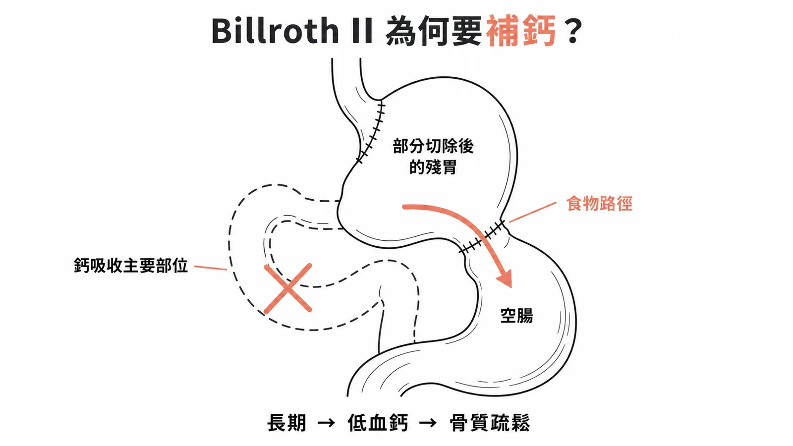 Billroth II術後食物繞過十二指腸導致鈣質吸收不良示意圖