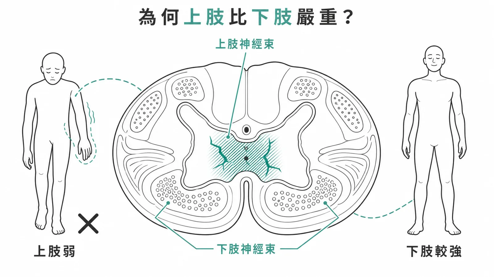 中央脊髓症候群示意圖：脊髓中央上肢神經束受損嚴重而周邊下肢神經束相對保留