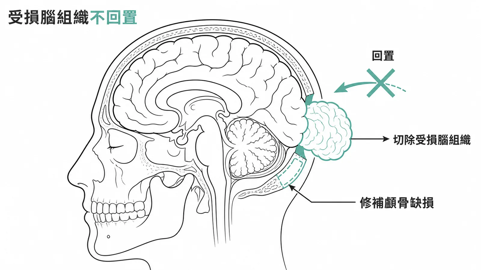 腦膨出手術：受損腦組織切除而非回置，並修補顱骨缺損