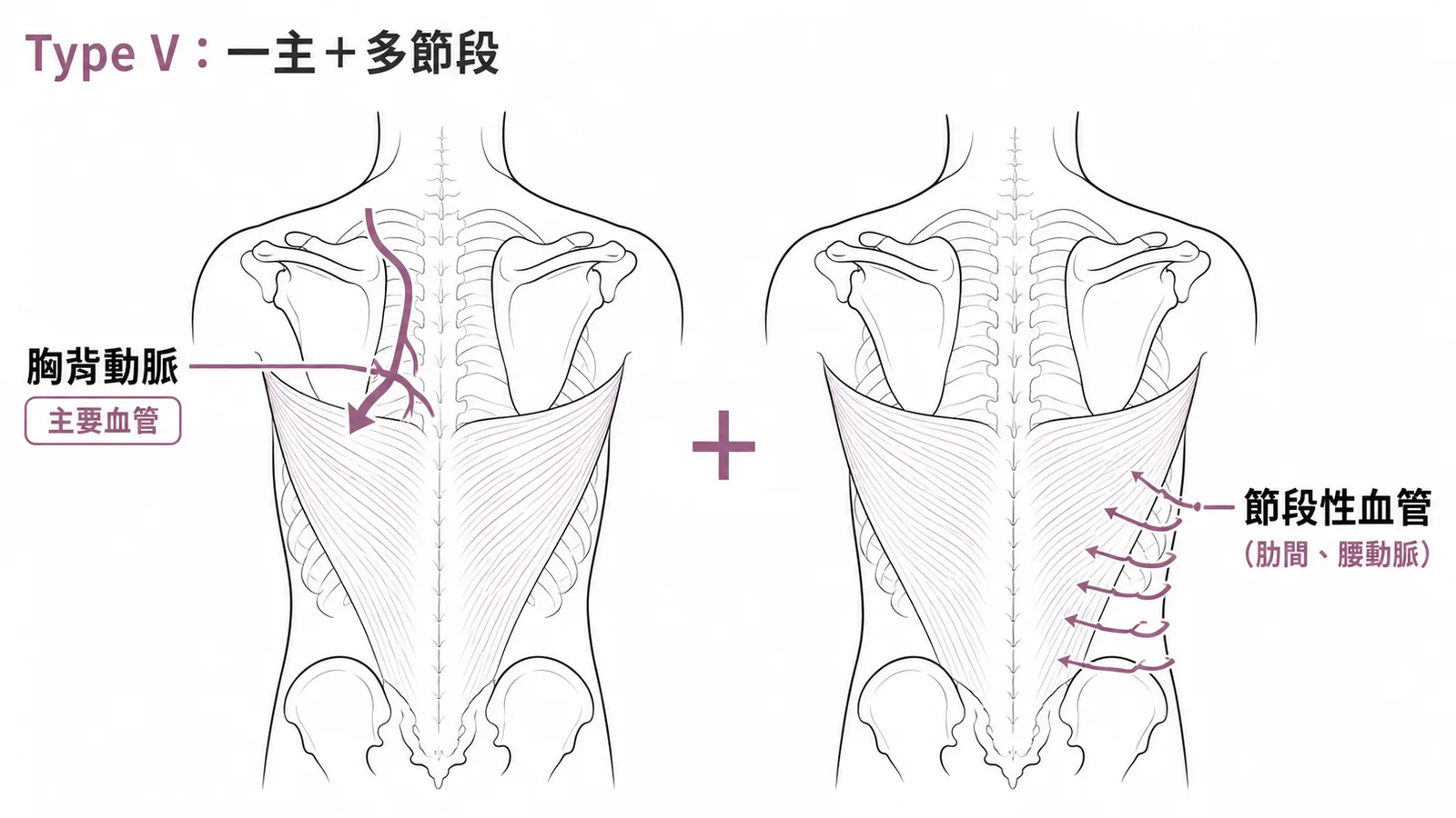 闊背肌皮瓣 Type V：一條主要胸背動脈加多條節段性血管