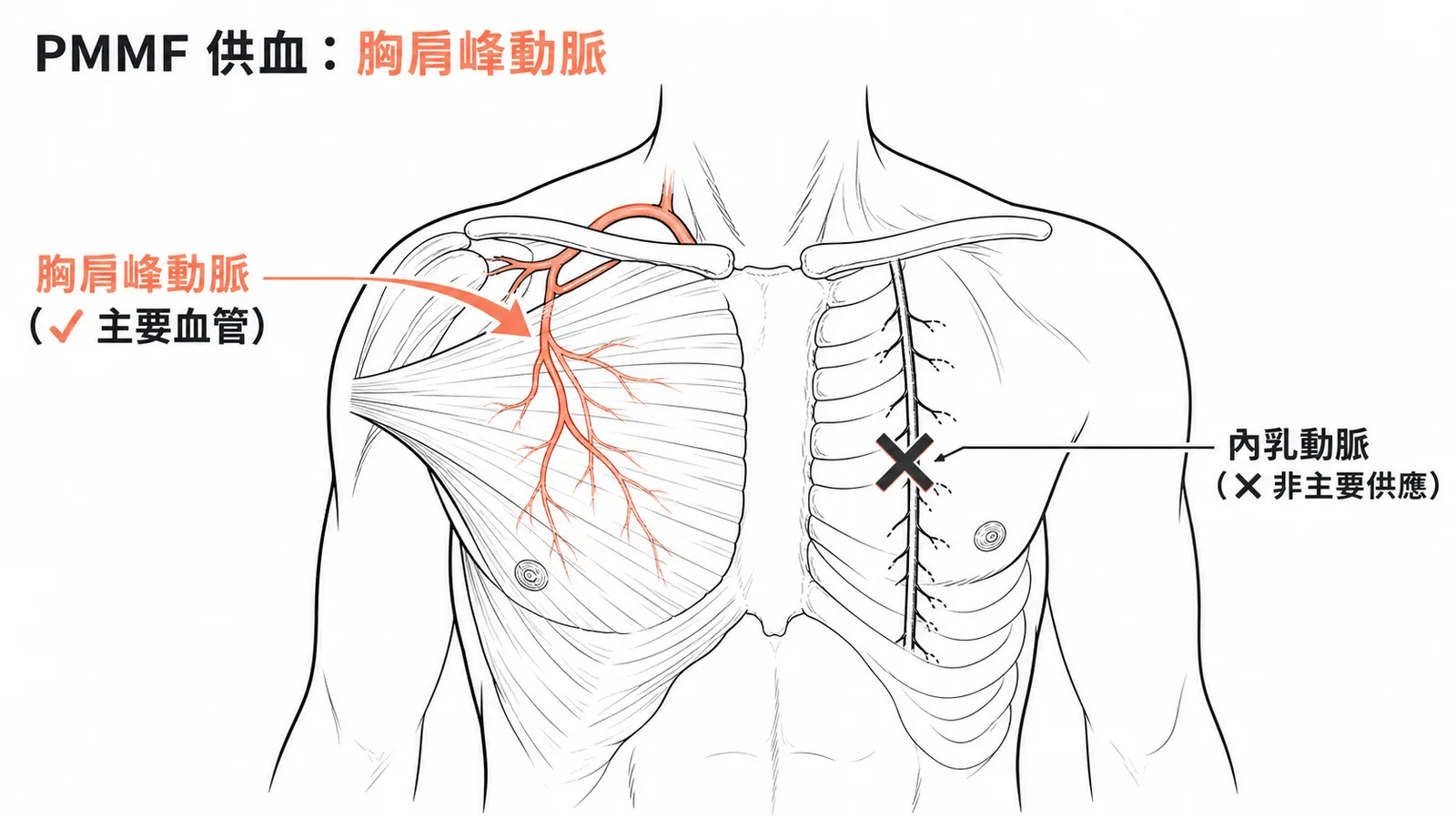 胸大肌皮瓣主要供血為胸肩峰動脈，非內乳動脈