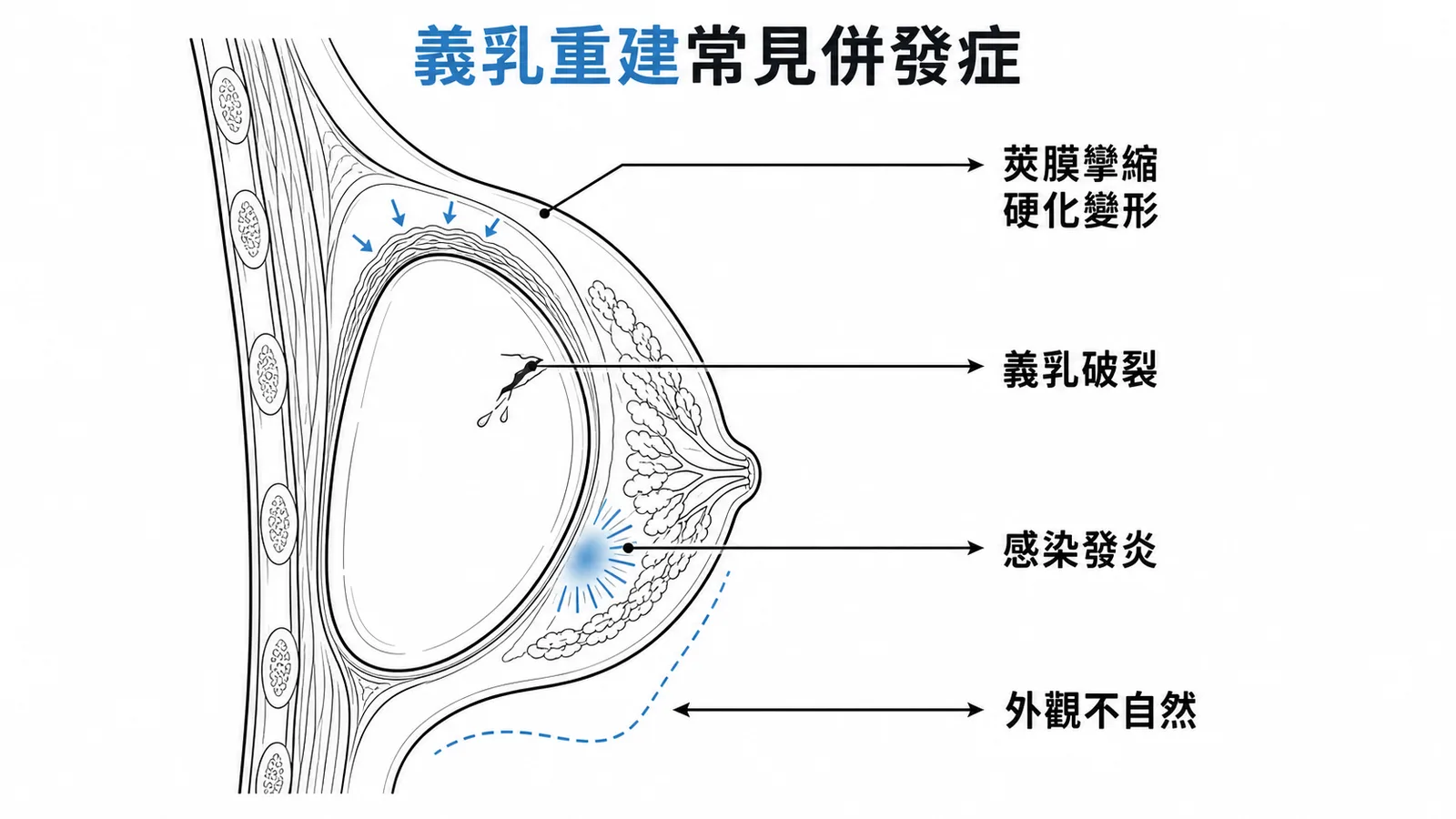 義乳重建常見併發症：莢膜攣縮、破裂、感染、外觀不自然