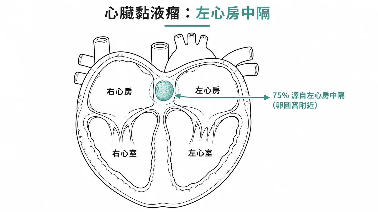 心臟黏液瘤 75% 源自左心房中隔卵圓窩附近