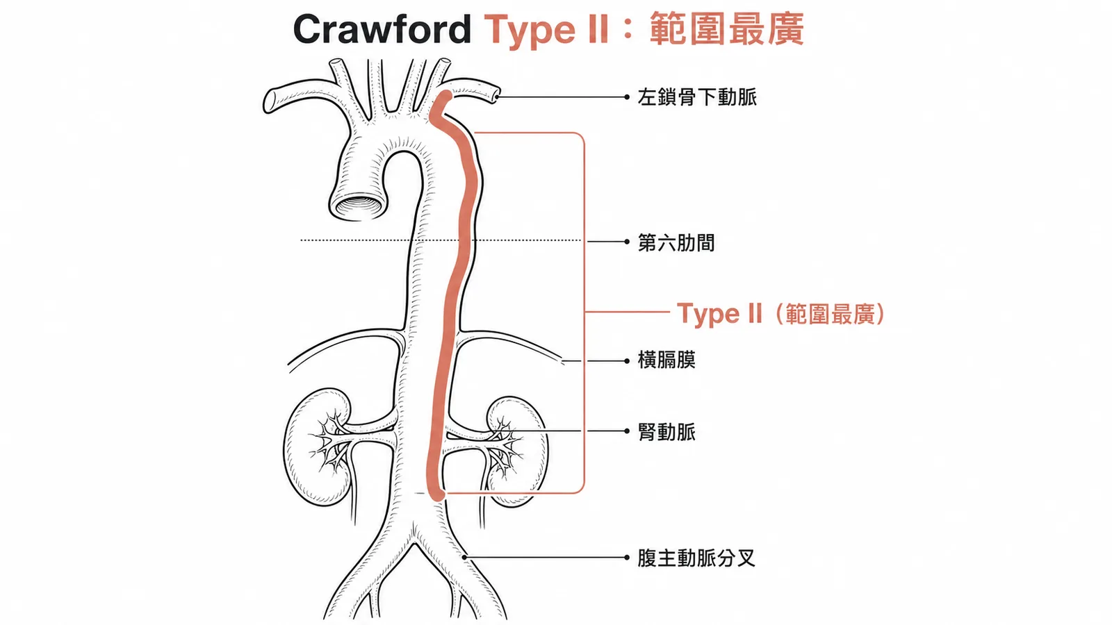 Crawford Type II 胸腹主動脈瘤：從左鎖骨下動脈至腎動脈以下，範圍最廣