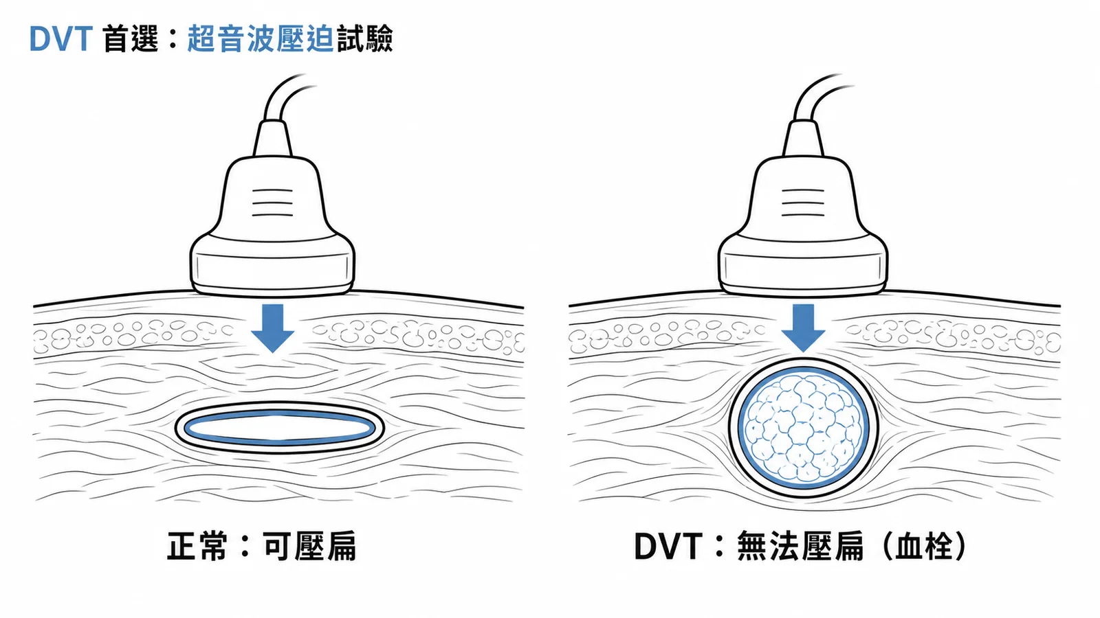DVT 診斷首選杜卜勒超音波壓迫試驗：正常可壓扁 vs 血栓無法壓扁