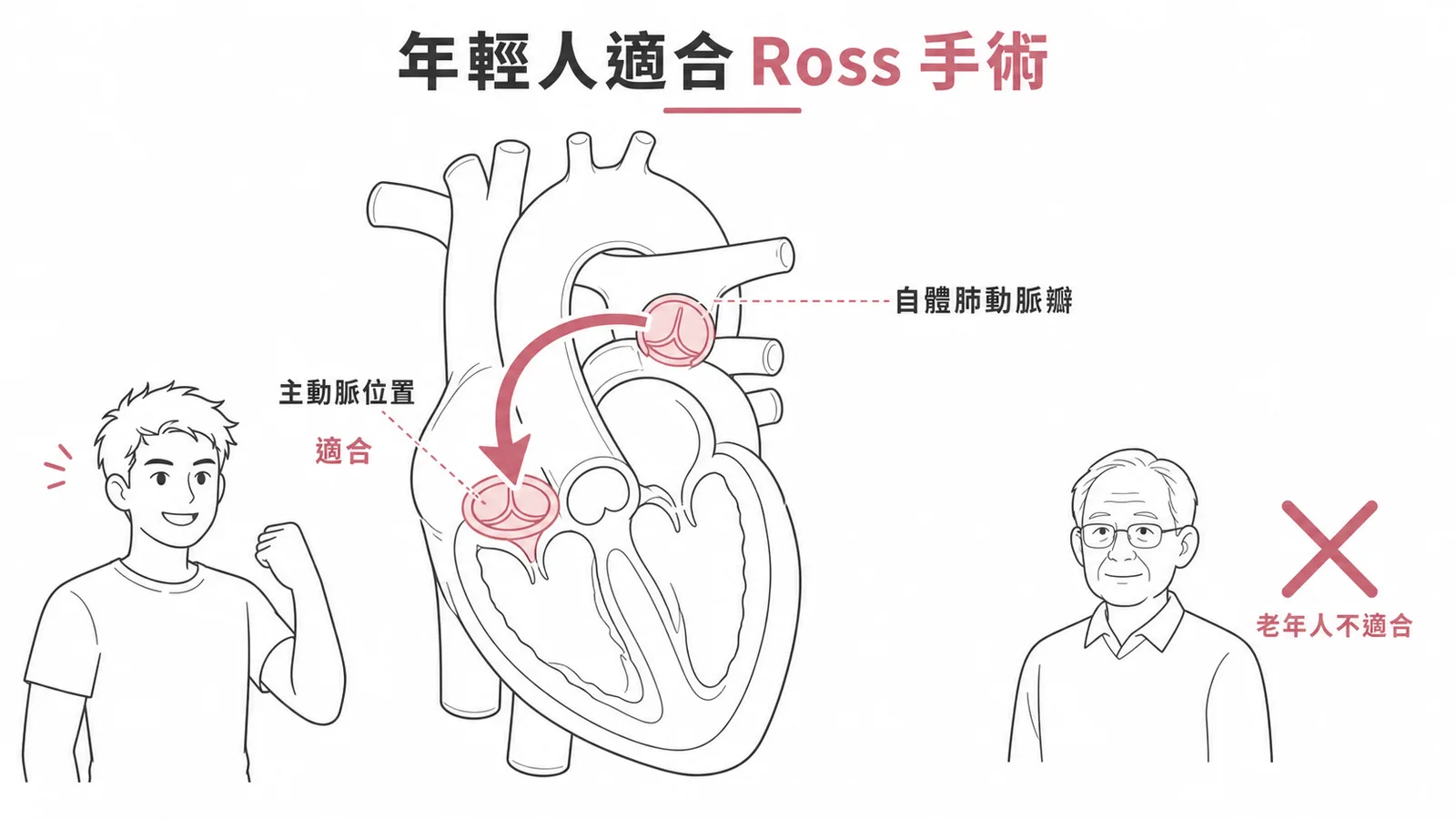Ross手術適合年輕人而非老年人的示意圖