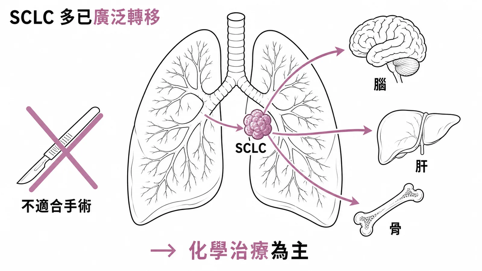 小細胞肺癌發現時多已廣泛轉移不適合手術的示意圖