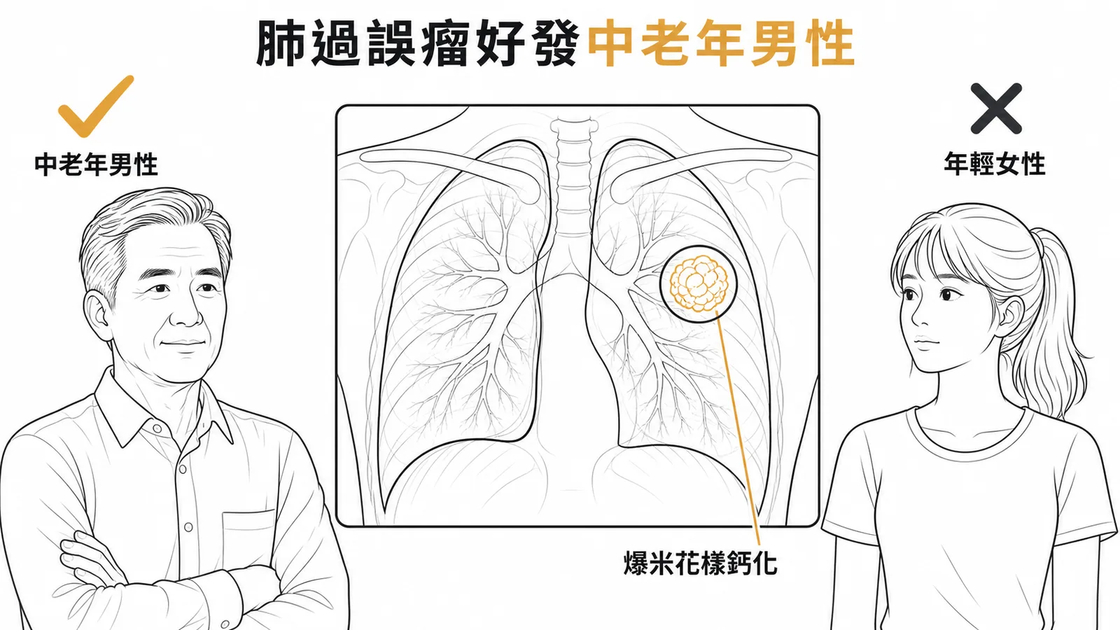 肺過誤瘤好發中老年男性而非年輕女性的示意圖
