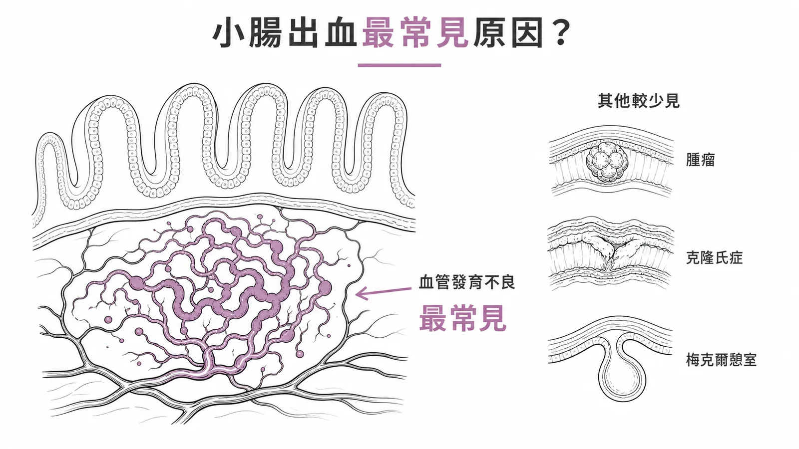 小腸出血最常見原因是血管發育不良的示意圖