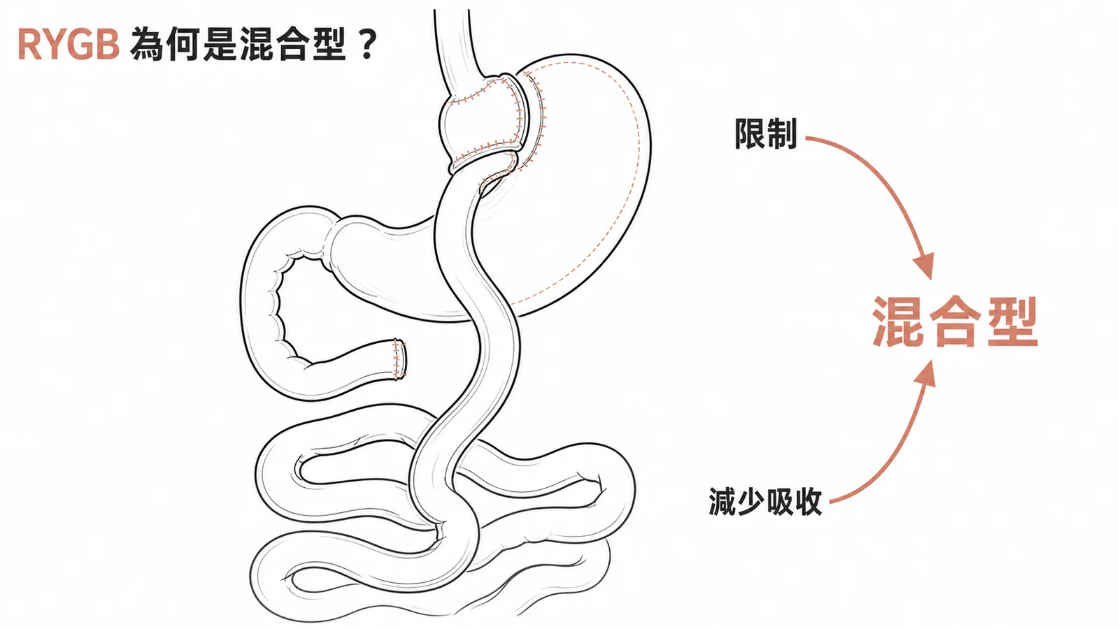 RYGB結合限制與吸收不良的混合型減重手術示意圖
