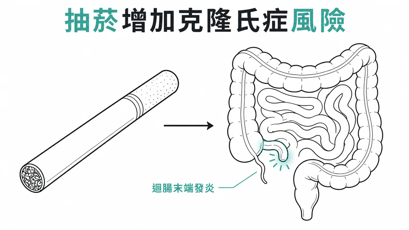 抽菸增加克隆氏症風險——香菸箭頭指向迴腸末端發炎示意