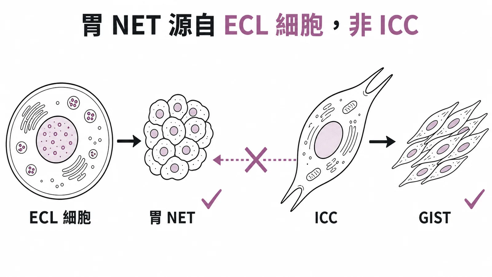 胃NET源自ECL細胞而非ICC——ECL細胞箭頭指向NET正確，ICC指向GIST正確，ICC指向NET打叉