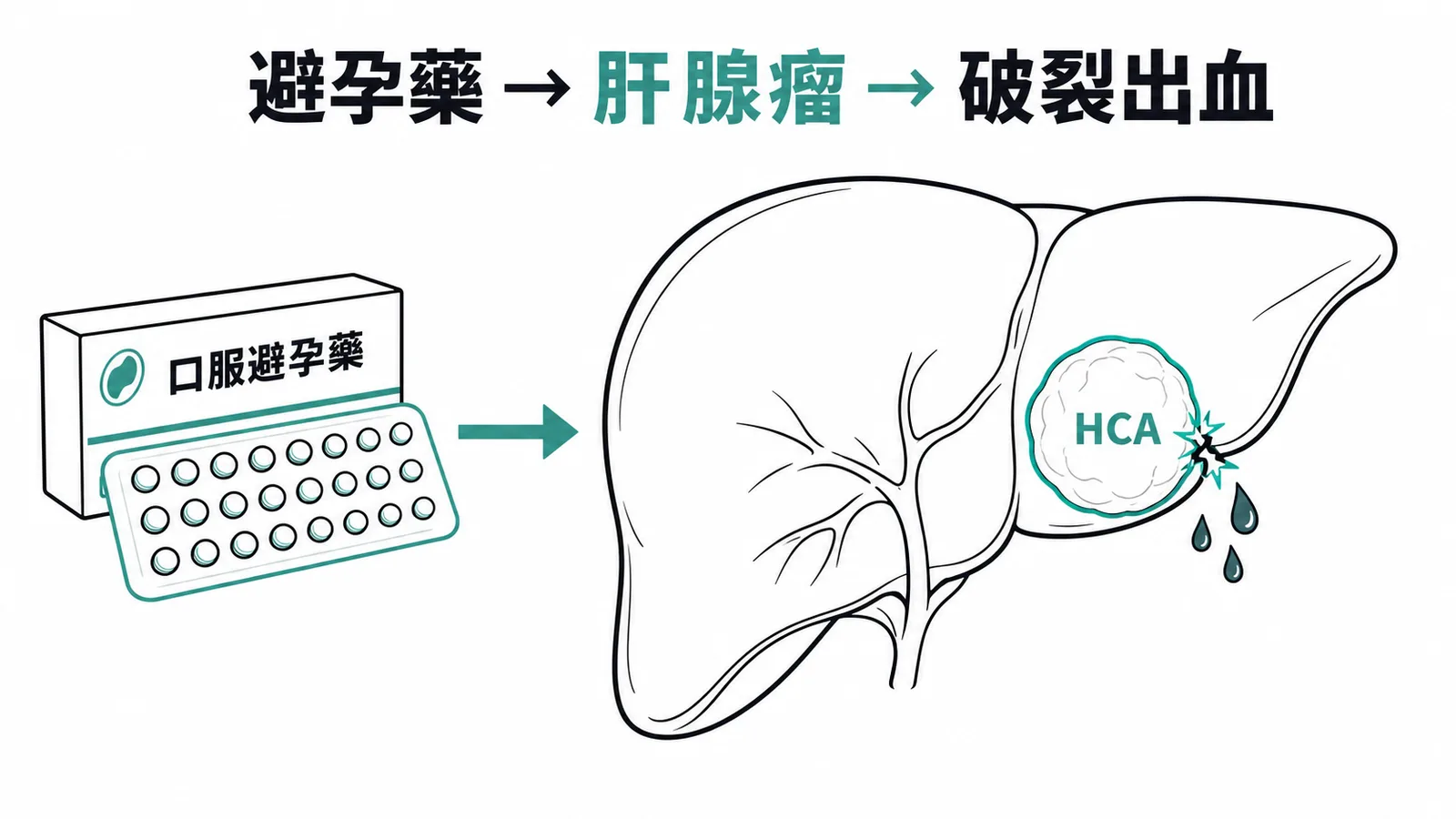 口服避孕藥導致肝細胞腺瘤，最大風險為破裂出血